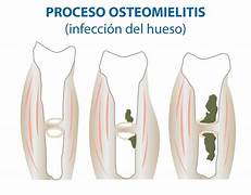 Progresión de la infección desde la herida crónica hacia el hueso: colonización, infección tisular y osteomielitis