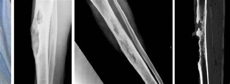 Radiografía de osteomielitis crónica: destrucción ósea, pérdida de cortical, secuestro óseo y reacción perióstica