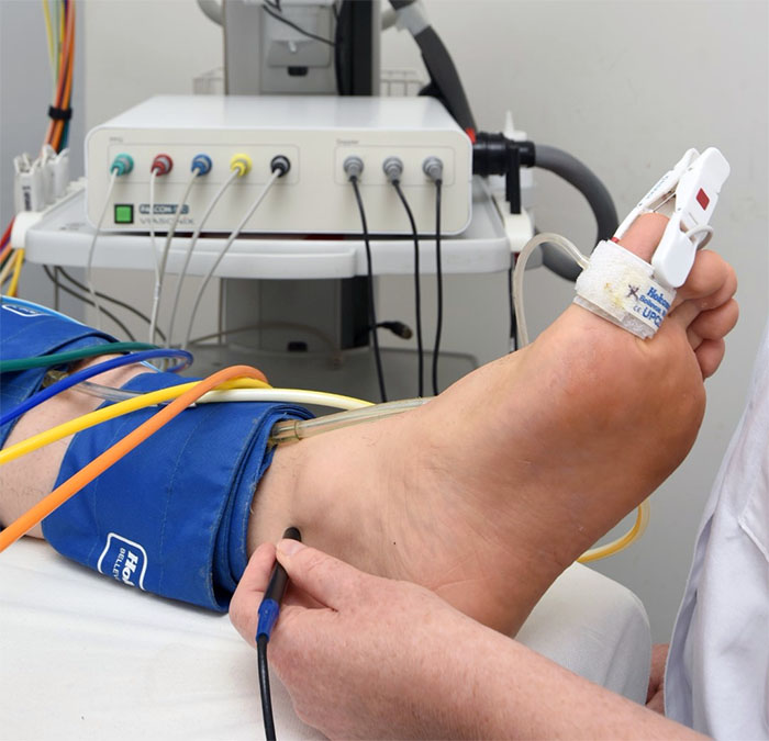 Medición del índice tobillo-brazo con Doppler — técnica correcta para evaluar perfusión arterial en úlceras de extremidad inferior