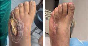 Pie diabético con necrosis extensa — el estadio que casi nunca debería llegar si la derivación fue a tiempo