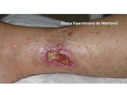 Úlcera de Martorell — aspecto clínico con borde violáceo característico y lecho necrótico