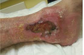 Úlcera venosa clásica — localización en maleolo interno con exudado abundante y piel con hemosiderina