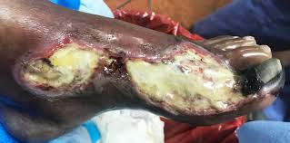 Úlcera arterial — bordes bien definidos tipo sacabocados, lecho pálido y localización distal