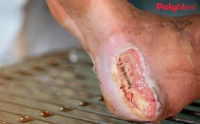 Maceración perilesional — piel blanca y arrugada por exudado mal gestionado en herida crónica