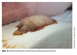 Apósito retirado con exudado — el patrón de distribución del exudado en el apósito es información clínica directa