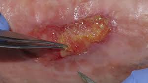 Lecho de herida con granulación y fibrina — comparativa visual para identificar el estado del tejido