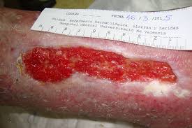 Lecho con granulación activa viable — el perfil ideal para un apósito de colágeno