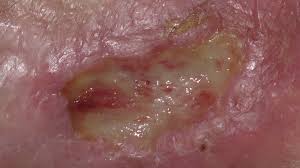 Herida crónica estancada con fibrina persistente — lecho con exceso de MMP que destruye la matriz en formación