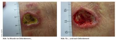 Herida crónica con tejido no viable antes y después del desbridamiento — preparación del lecho
