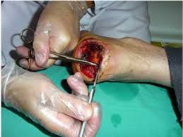 Desbridamiento enzimático con colagenasa en herida crónica — aplicación sobre tejido no viable