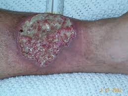 Pioderma gangrenoso: úlcera con borde violáceo socavado y eritema perilesional característico