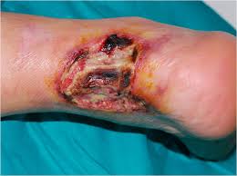 Pioderma gangrenoso en pierna: aspecto ulceroso con fondo necrótico y bordes irregulares inflamados
