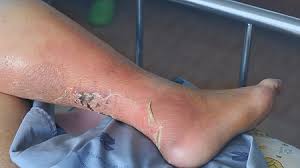 Úlcera venosa en pierna con edema importante, lipodermatoesclerosis perilesional y eccema varicoso