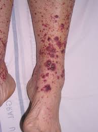 Púrpura palpable en extremidad inferior: lesiones purpúricas confluentes no blanqueables características de vasculitis leucocitoclástica