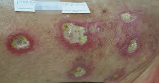 Úlcera vasculítica en pierna: necrosis central con halo eritematoso-purpúrico perilesional activo, borde irregular plano