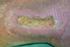 Herida con lecho limpio tras resolución de la infección por Pseudomonas y control del biofilm