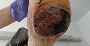 Escara en talón con signos de alarma: eritema perilesional activo, exudado que escapa por los bordes, zona de fluctuación — indicación de actuación urgente