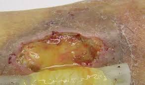 Exudado purulento espeso en herida crónica infectada — color verdoso-amarillento, opaco, con olor fétido indicando infección activa