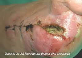 Herida crónica con esfacelo e infección local activa — signos STONEES presentes: exudado purulento, tejido friable, eritema perilesional