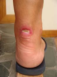 Úlcera de Martorell bilateral — localización laterodorsal con necrosis extensa y borde activo