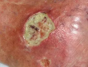 Úlcera de Martorell — red lipstick sign y borde violáceo en pierna laterodorsal