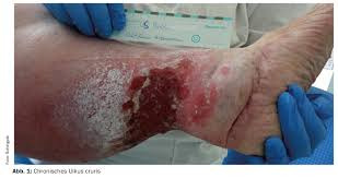 Úlcera venosa en pierna con edema marcado, lipodermatoesclerosis y exudado abundante — indicación de compresión terapéutica multicapa