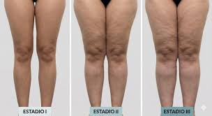 Lipedema en extremidades inferiores: acumulación bilateral y simétrica de tejido adiposo desde caderas hasta tobillos con respeto del pie característico