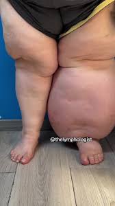 Lipedema avanzado estadio III con lipolinfedema: grandes lobulillos de tejido adiposo fibrótico, deformación del contorno y edema superpuesto