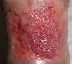 Bordes de herida crónica con diferentes alteraciones — diagnóstico diferencial entre epíbole, maceración perilesional e hiperqueratosis