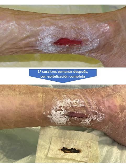 Herida crónica antes y después del tratamiento con alginato: exudado abundante con piel perilesional macerada antes, epitelización completa tres semanas después
