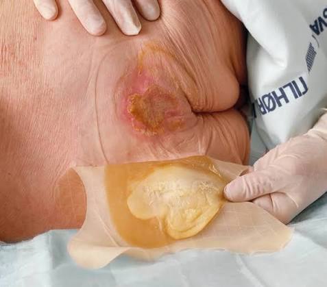 LPP categoría I en sacro con eritema no blanqueable — indicación de hidrocoloide fino para protección y prevención de progresión a categoría II