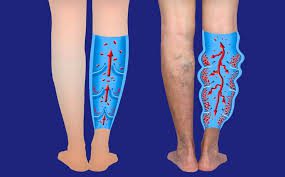 Insuficiencia venosa crónica estadio avanzado — lipodermatoesclerosis pigmentación ocre edema maleolar cambios tróficos tercio inferior pierna CEAP C4-C5