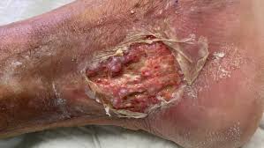 Progresión insuficiencia venosa crónica estadios CEAP C3 a C6 — edema varices lipodermatoesclerosis úlcera venosa activa pierna