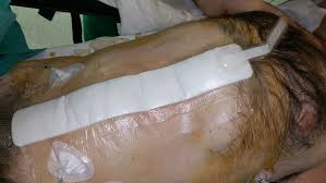 Manejo de dehiscencia de herida quirúrgica con cura húmeda y apósito para cierre por segunda intención