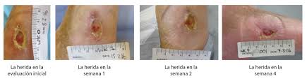 Evolución de herida crónica tratada con PHMB polihexanida — progresión semana a semana desde la evaluación inicial hasta la semana 4 con reducción de carga bacteriana y mejoría del lecho
