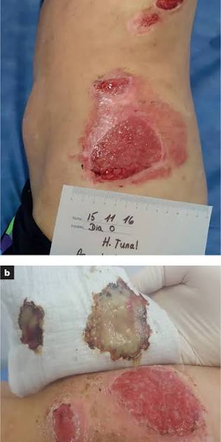 Apósito de hidrofibra Aquacel sobre herida crónica con exudado — gel de carboximetilcelulosa sódica absorbiendo exudado y transformándose en gel cohesivo sobre el lecho