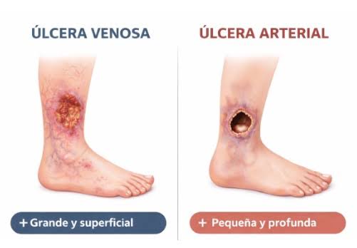 Pie isquémico arteriopatía periférica — piel brillante sin vello fría cambios tróficos dedos necrosis signos exploración índice tobillo-brazo