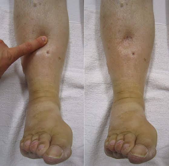 Edema en extremidades inferiores — signo de la fóvea positivo edema blando bilateral maleolar insuficiencia venosa crónica