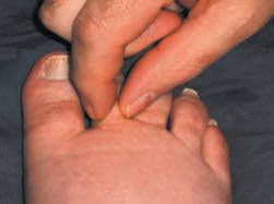 Linfedema en extremidad inferior signo de Stemmer positivo afectación dorso del pie piel engrosada edema duro sin fóvea