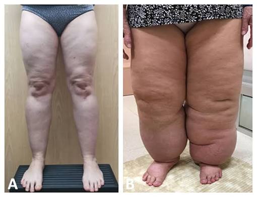 Lipedema bilateral distribución simétrica columnar extremidades inferiores respeto del pie diagnóstico diferencial linfedema