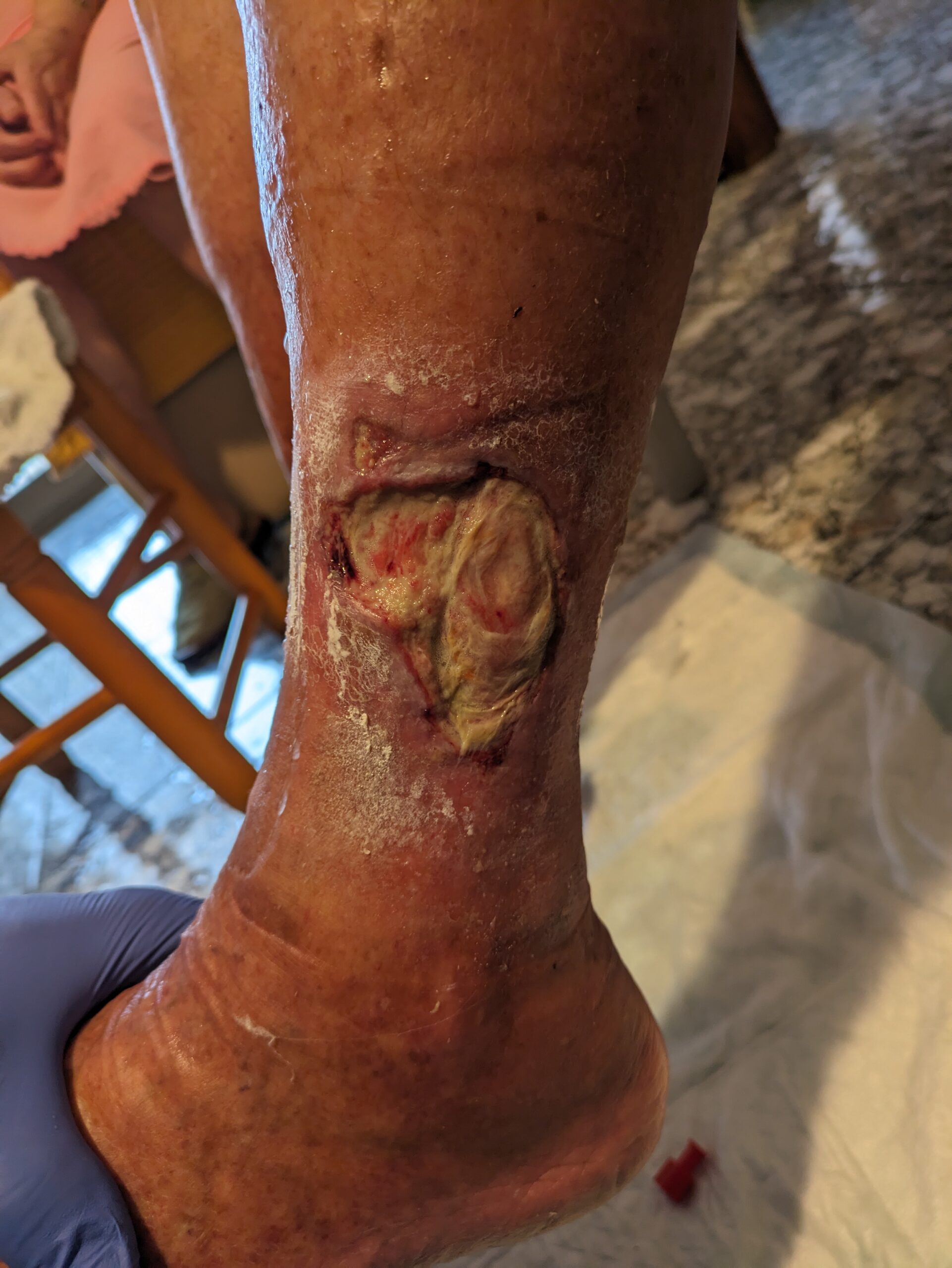 Herida crónica con esfacelo y tejido desvitalizado indicación de desbridamiento enzimático con colagenasa Iruxol Mono