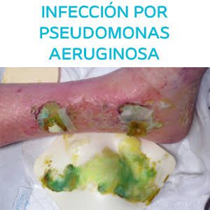 Herida con exudado verdoso azulado característico de infección por Pseudomonas aeruginosa