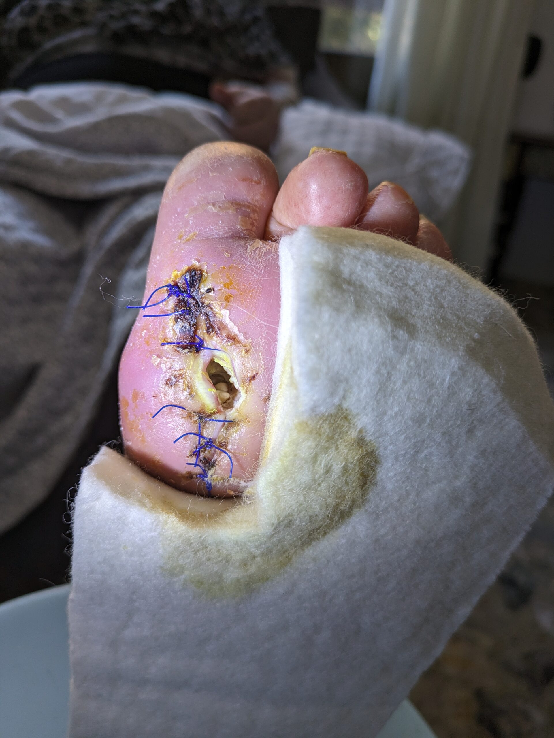 Úlcera pie diabético con fístula herida hipóxica neuropática isquémica candidata oxigenoterapia hiperbárica NATROX